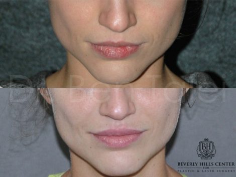 Lip Enhancement - Front