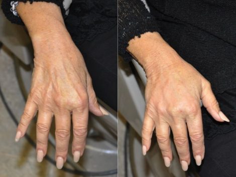 Beverly Hills Center Female Patient Before and After Hand Rejuvenation Procedure