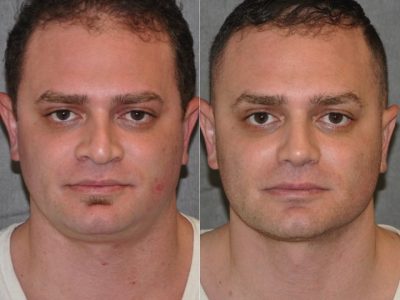 Revision Rhinoplasty & Profound MicroLift – Front