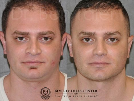 Revision Rhinoplasty & Profound MicroLift – Front