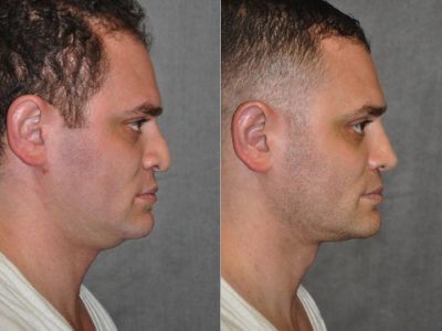 Revision Rhinoplasty & Profound MicroLift – Right Side