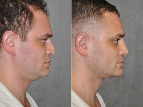 Revision Rhinoplasty & Profound MicroLift – Right Side