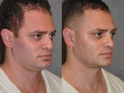 Revision Rhinoplasty & Profound MicroLift – Right Side