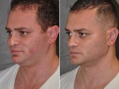 Revision Rhinoplasty & Profound MicroLift – Left Side