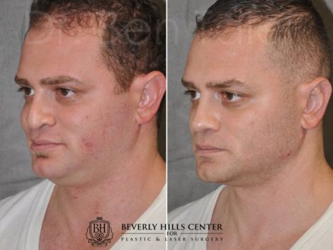 Revision Rhinoplasty & Profound MicroLift – Left Side
