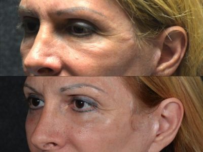Lower Eyelid Rejuvenation - Left Side