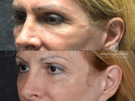 Lower Eyelid Rejuvenation - Left Side