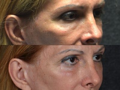 Lower Eyelid Rejuvenation - Right Side