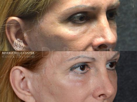 Lower Eyelid Rejuvenation - Right Side