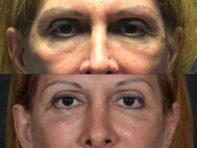 Lower Eyelid Rejuvenation - Front