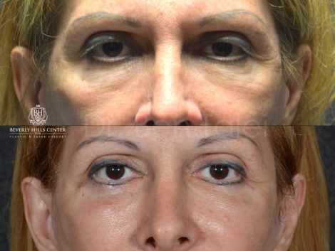 Lower Eyelid Rejuvenation - Front