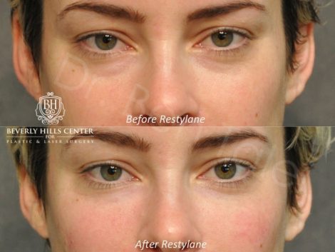 Beverly Hills Center Female Patient Before and After Non-surgical Under Eye Rejuvenation Procedure
