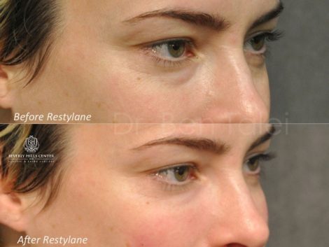 Beverly Hills Center Female Patient Before and After Non-surgical Under Eye Rejuvenation Procedure