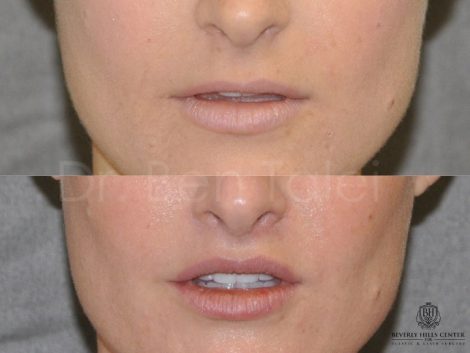 Lip Lift - Front