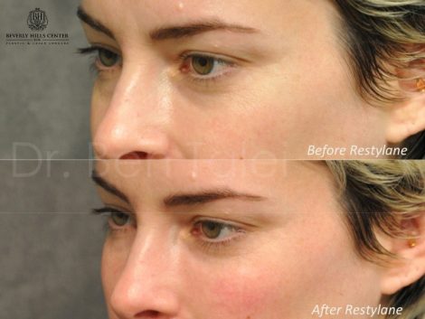 Beverly Hills Center Female Patient Before and After Non-surgical Under Eye Rejuvenation Procedure