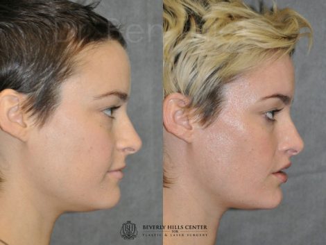 Lip Lift - Right Side
