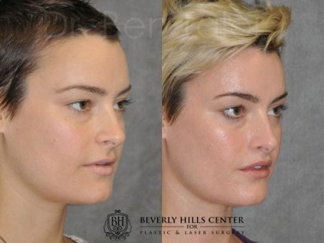 Lip Lift - Right Side
