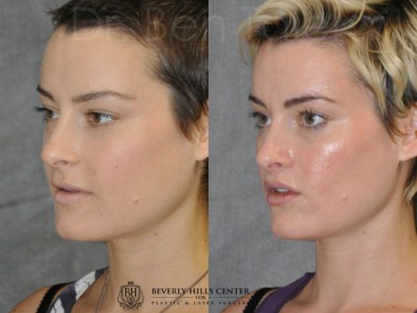 Lip Lift - Left Side