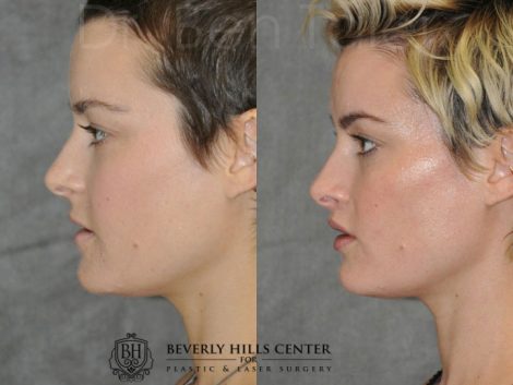 Lip Lift - Left Side