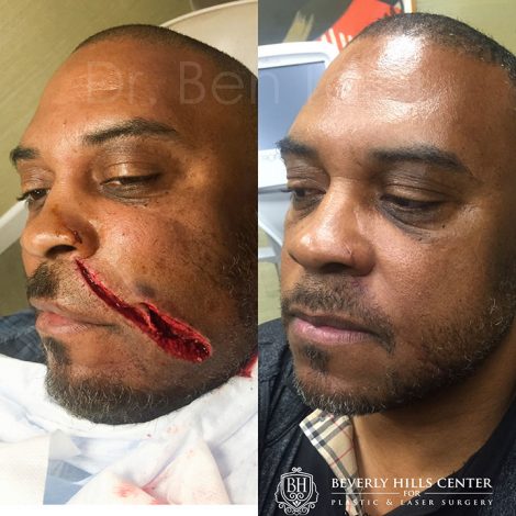 Beverly Hills Center Afro-American Male Patient Before and After Cheek Scar Removal