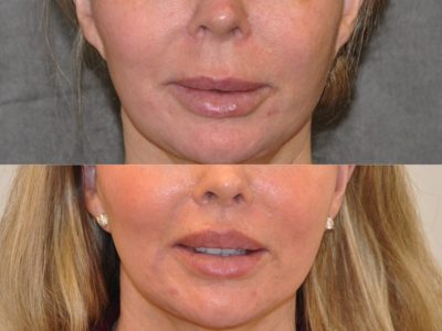 Modified Upper Lip Lift - Front
