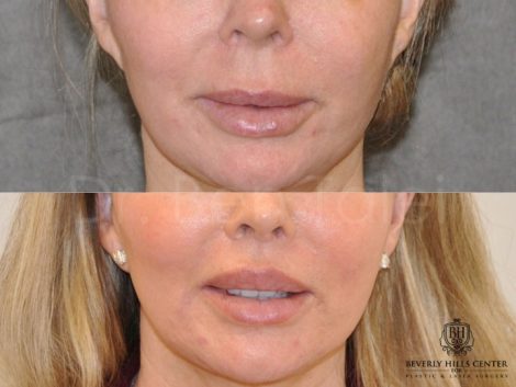 Modified Upper Lip Lift - Front