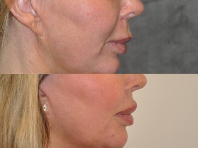Modified Upper Lip Lift - Right Side