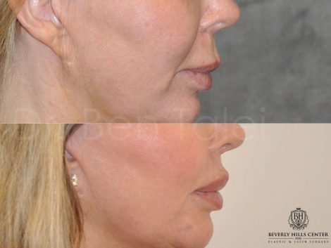 Modified Upper Lip Lift - Right Side
