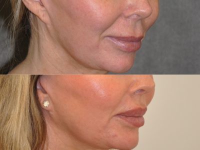 Modified Upper Lip Lift - Right Side