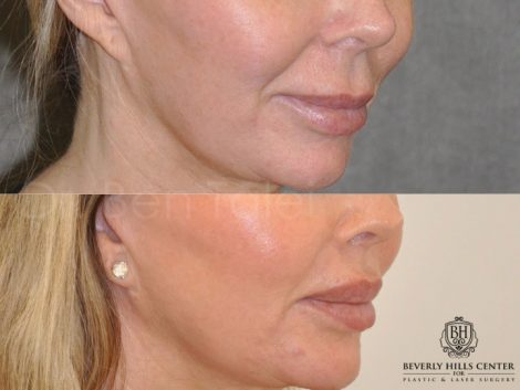 Modified Upper Lip Lift - Right Side