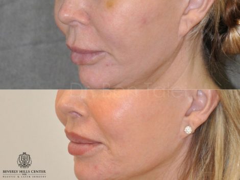 Modified Upper Lip Lift - Left Side