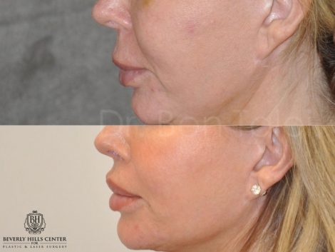 Modified Upper Lip Lift - Left Side