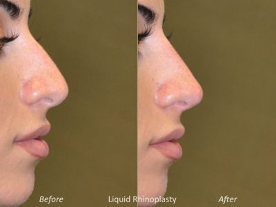 Non Surgical Rhinoplasty / Liquid Nosejob