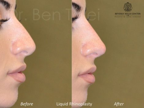 Non Surgical Rhinoplasty / Liquid Nosejob