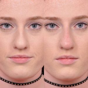 Non surgical rhinoplasty - Front