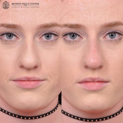 Non surgical rhinoplasty - Front
