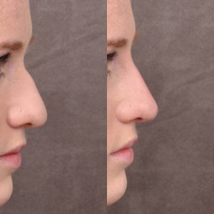 Non surgical rhinoplasty - Right Side