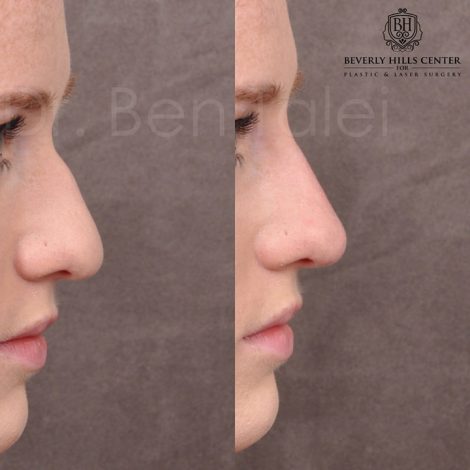 Non surgical rhinoplasty - Right Side