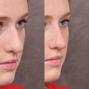 Non surgical rhinoplasty - Right Side