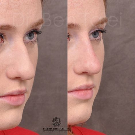 Non surgical rhinoplasty - Right Side