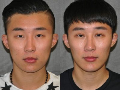 Chin Implant and Buccal Fat Reduction - Front