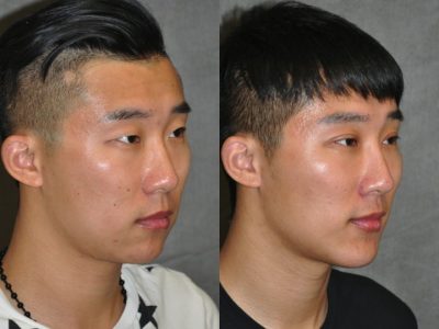 Chin Implant and Buccal Fat Reduction - Right Side