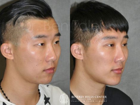 Chin Implant and Buccal Fat Reduction - Right Side