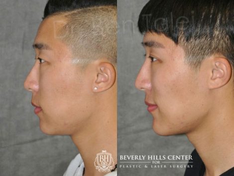 Beverly Hills Center Male Patient Before and After Chin Implant and Buccal Fat Reduction Procedure