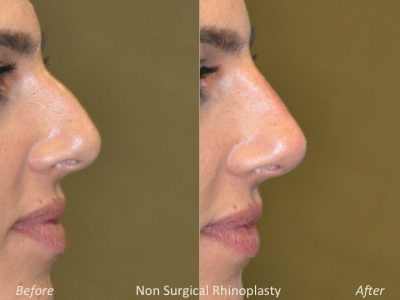 Non Surgical Rhinoplasty / Liquid NoseJob