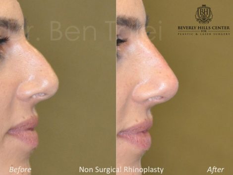 Non Surgical Rhinoplasty / Liquid NoseJob