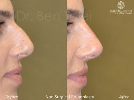 Non Surgical Rhinoplasty / Liquid Nosejob