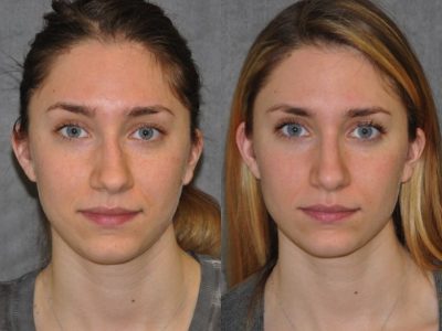 Minimally Invasive Rhinoplasty & Nostril Lightening - Front