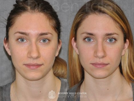 Minimally Invasive Rhinoplasty & Nostril Lightening - Front