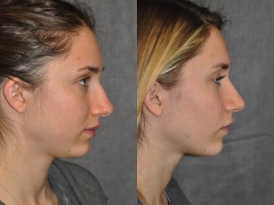 Minimally Invasive Rhinoplasty & Nostril Lightening - Right Side